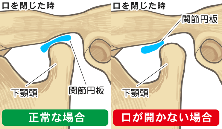 関節円板の障害（Ⅲ型 ）