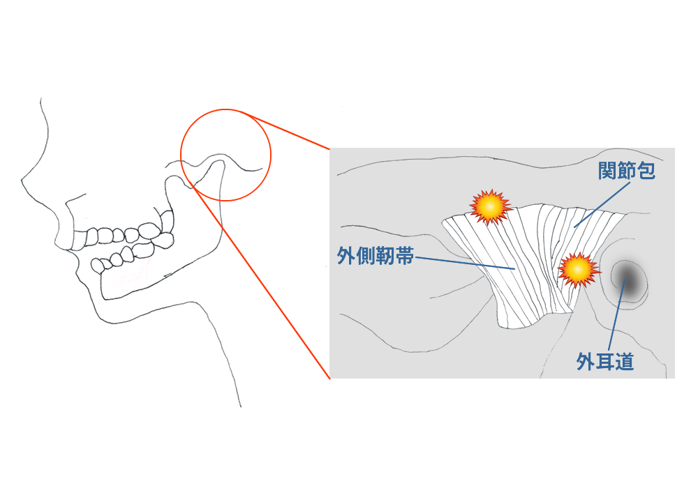 関節包・靭帯の障害（Ⅱ型 ）