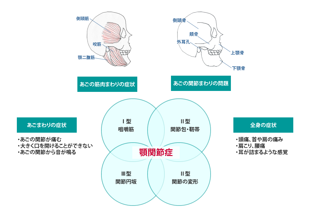 顎関節症とは