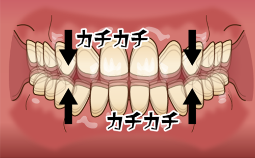 タッピング（歯をかちかちと咬みあわせる）