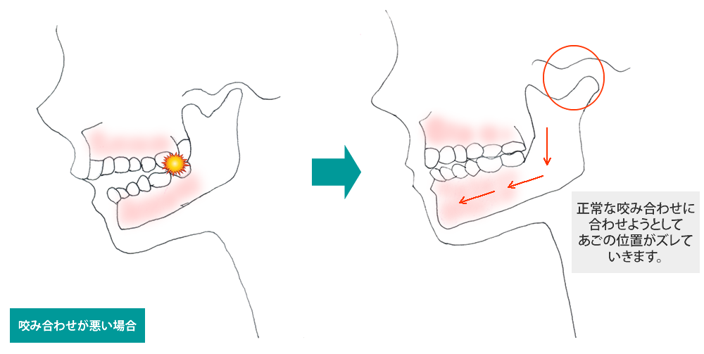 咬みあわせの異常(咬合干渉)